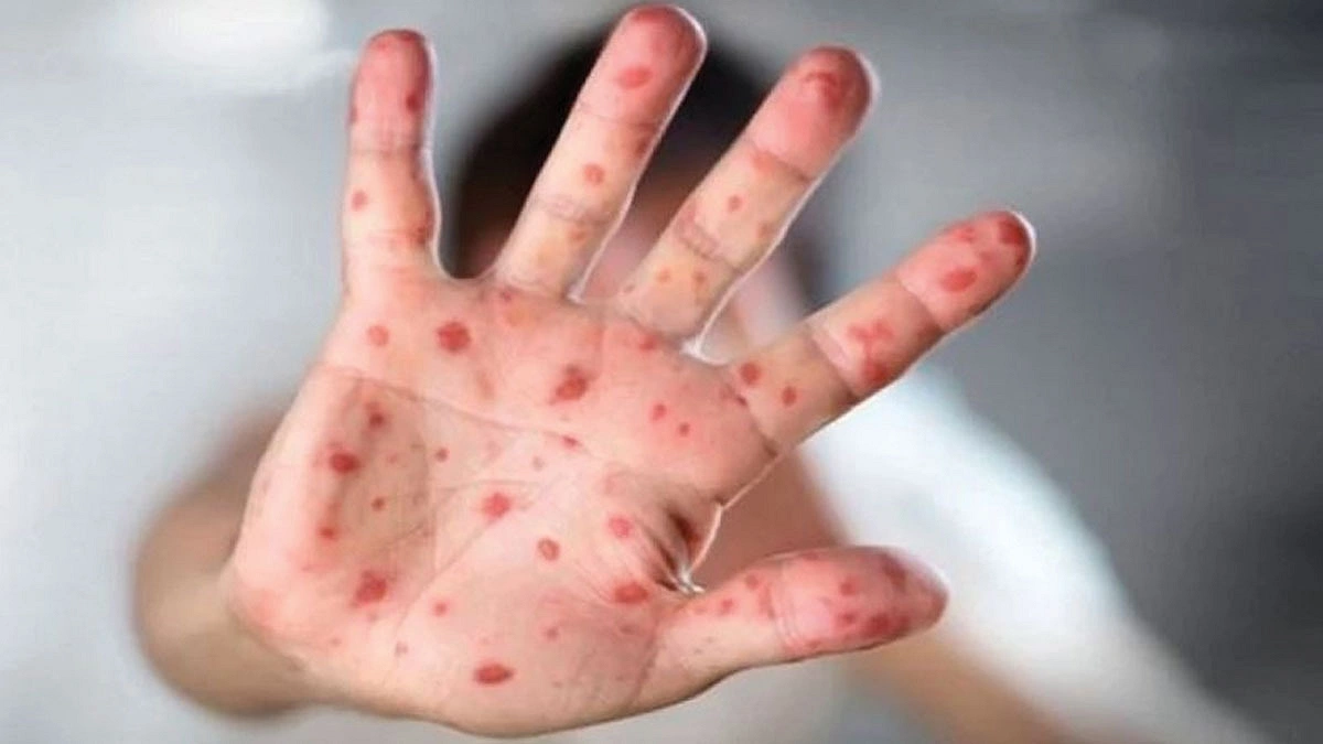 হামে দিনে গড়ে আক্রান্ত ১০৫৬ আরও ৭ মৃত্যু